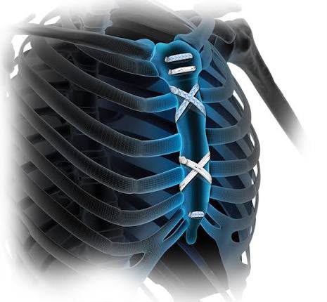Producto Arthrex de cardiotorácica