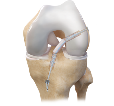 Producto Arthrex de rodilla